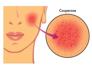 causes-couperose