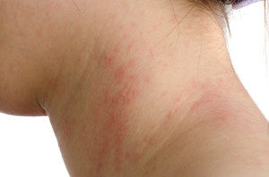 eczema-seve-de-bouleau