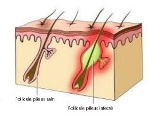 poil incarne barbe