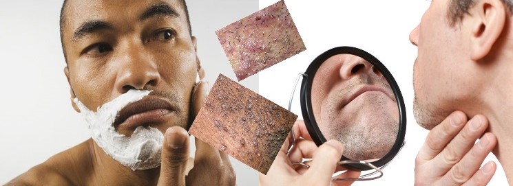 Comment prévenir la pseudo-folliculite de la barbe ?