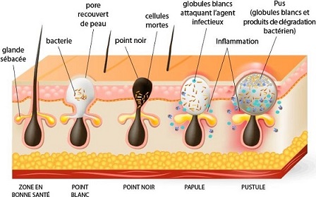 solutions-acne